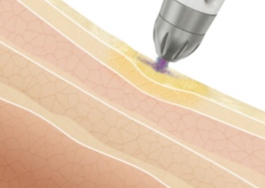 德國SEYO水光儀,LP3德國原裝進口安瓶,護膚,美容,醫思欣泰